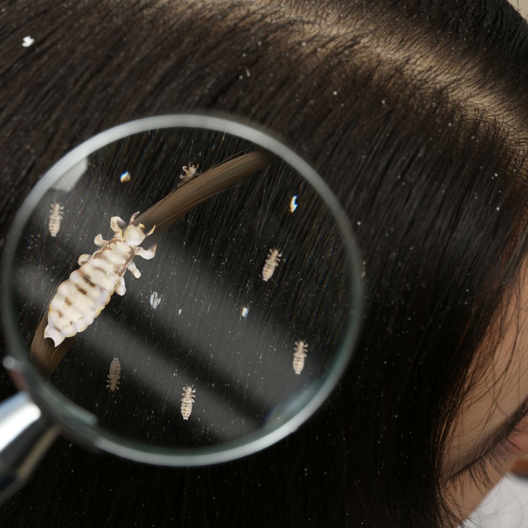 poux sur cheveux grossissement loupe